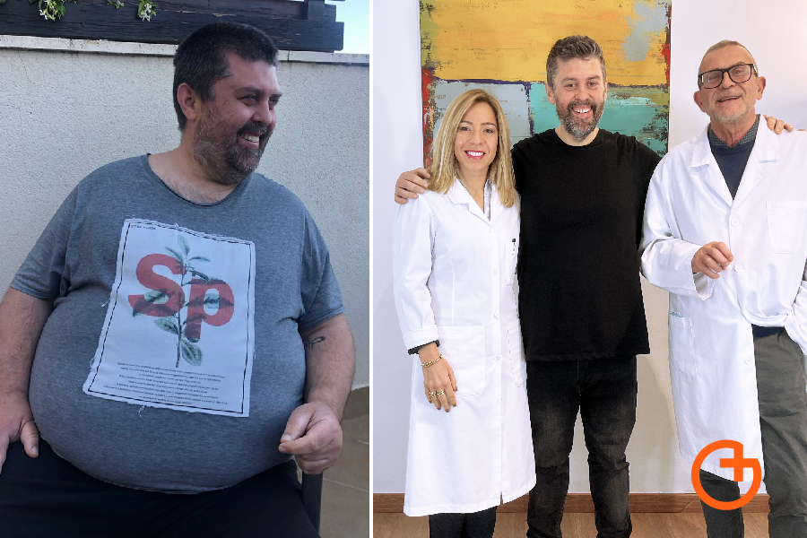Mi experiencia con la cirugía bariátrica: perder 72 kilos en 10 meses