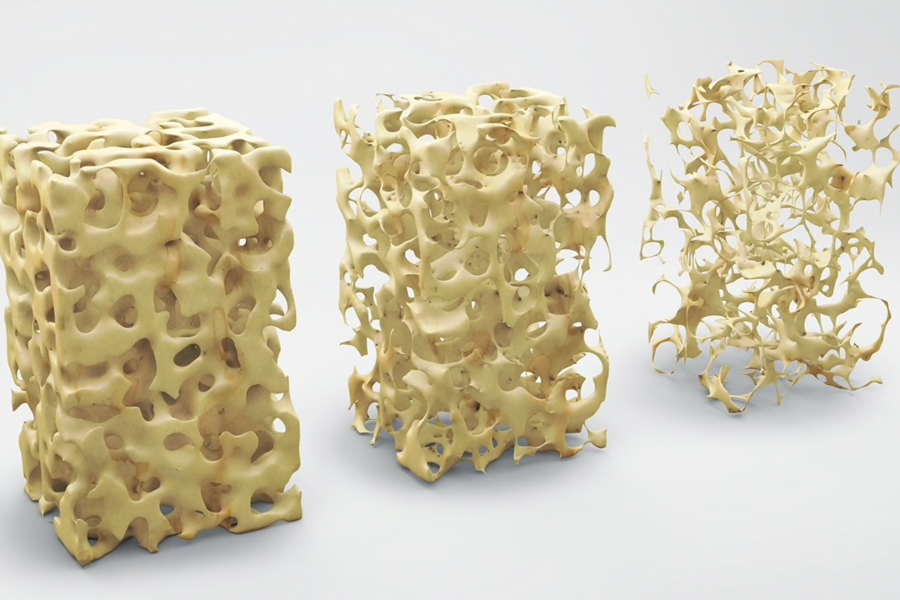 osteoporosis-densidad masa ósea